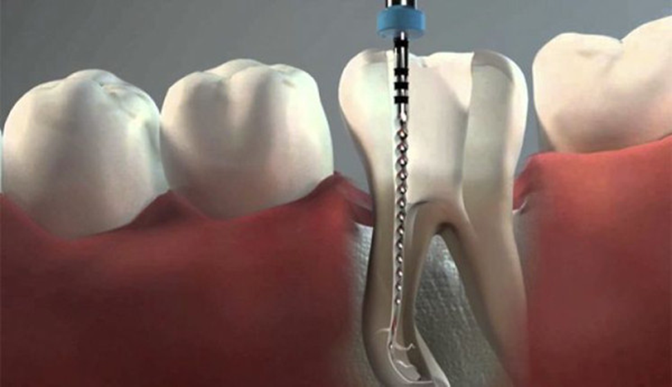 Limas de Endodoncia: Instrumental esencial en el tratamiento de conductos radiculares